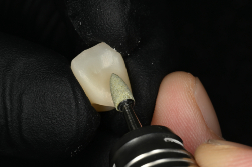 前歯舌側面の修正シーン