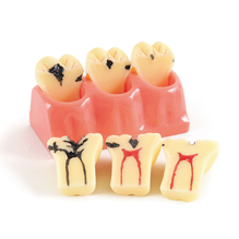 カリエス臼歯用モデル